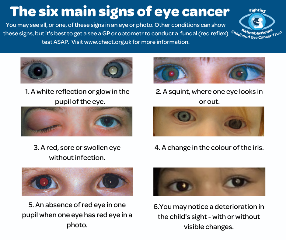 signs and symptoms of retinoblastoma